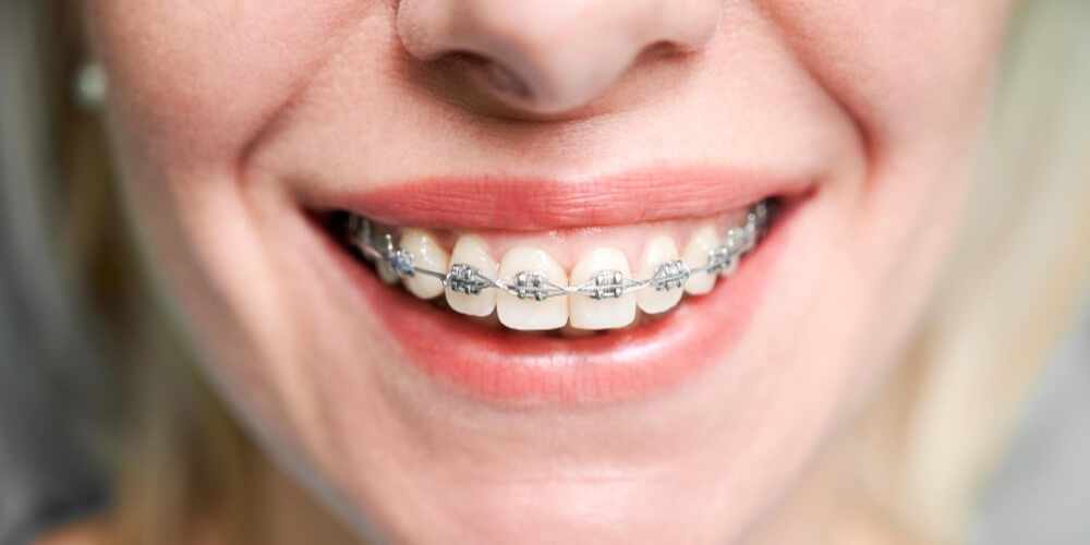 self lingual braces in surat gujarat
